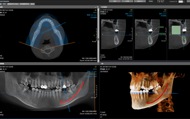 CBCT三维影像系统图_文章配图640x400.jpg